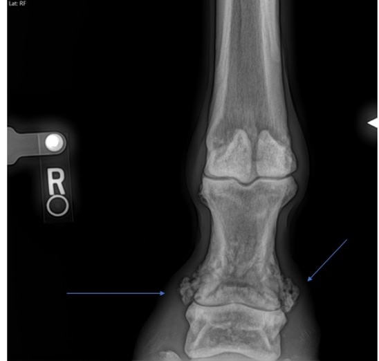 X-ray of a horse affected by high ringbone. The arrows are pointing at the excessive bone growth on either side of the joint.